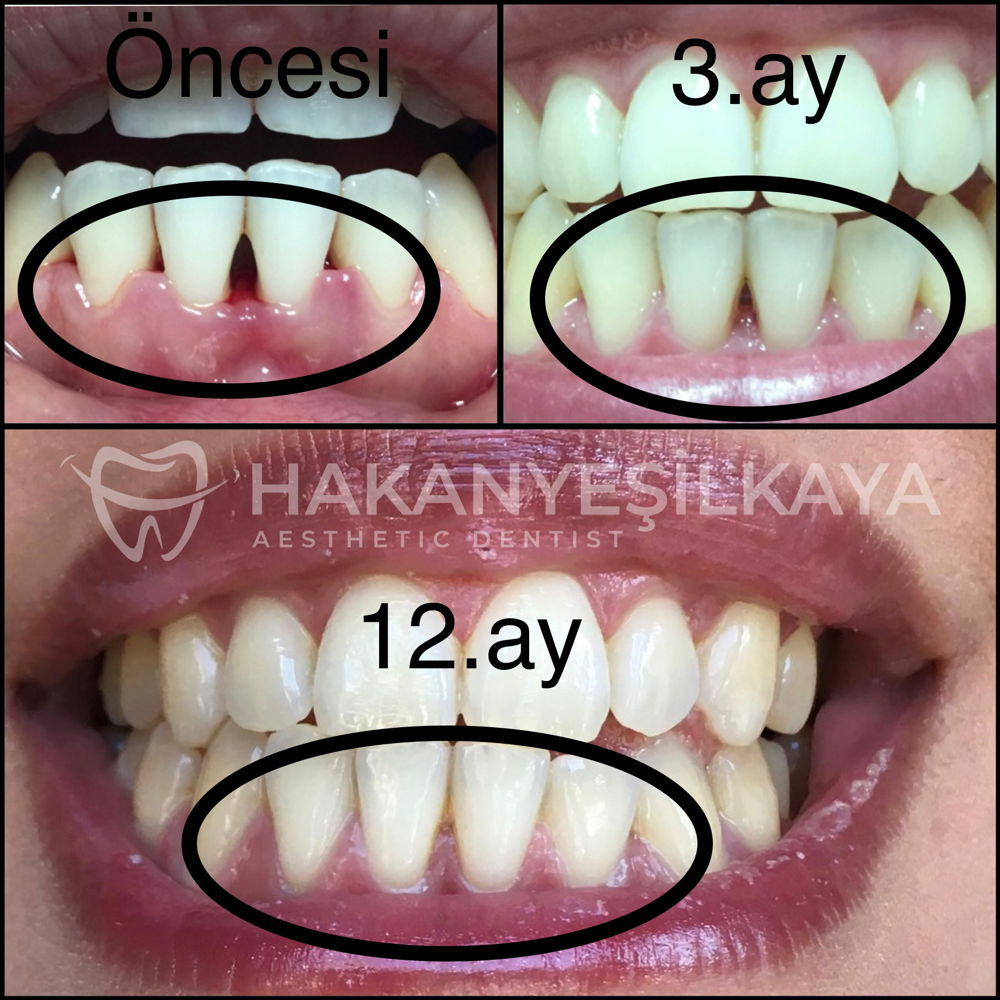 Diş Eti Tedavisi