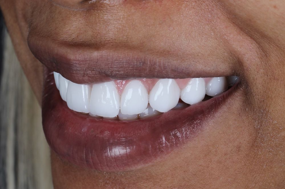 Smile Design